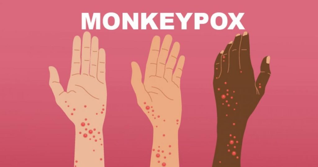 Monkeypox Exposed a Big Crack in Public Health: To Heal It, Look to Primary Care